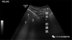 【超声随响】第25期 气性膀胱炎 “消失”的膀胱